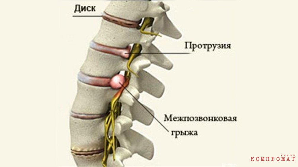 Протрузия, грыжа и хондроз — профильные заболевания инкассаторов
